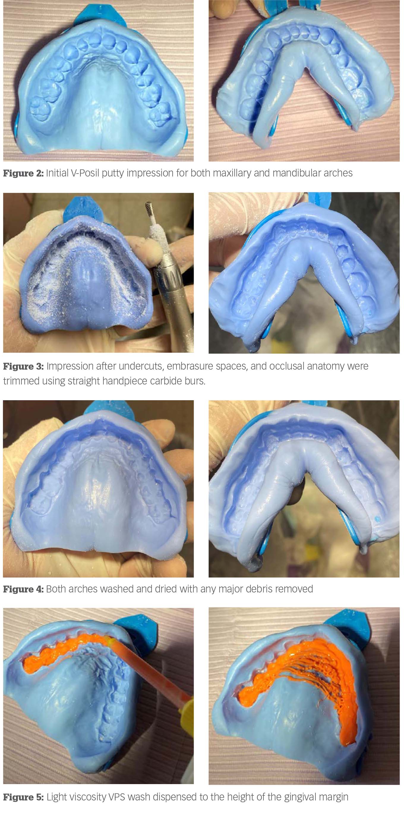 Better orthodontic impressions with the putty + wash method
