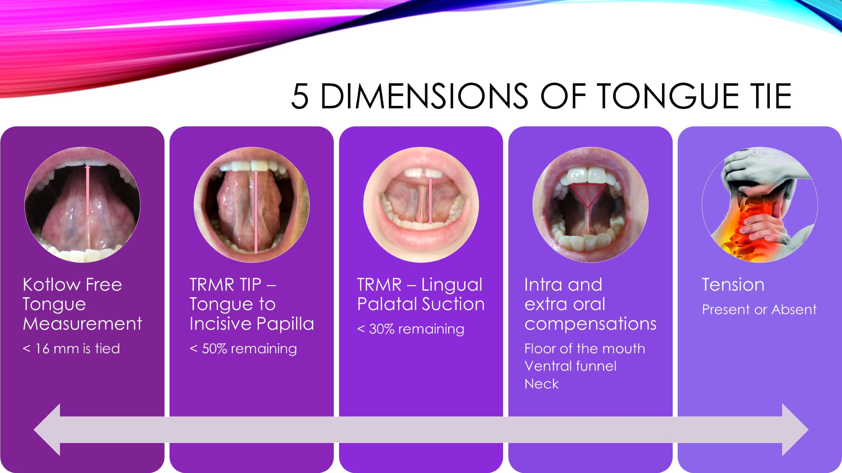 diagnosing a posterior tongue tie
